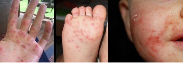 home remedies for hand foot mouth virus
